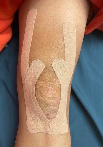 tape-rodilla